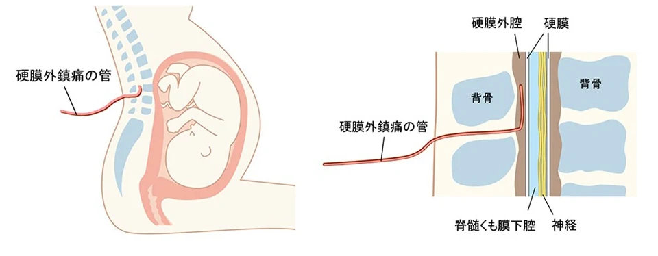 硬膜外麻酔のしくみ